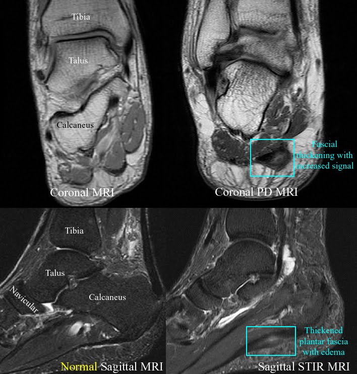Arch Pain