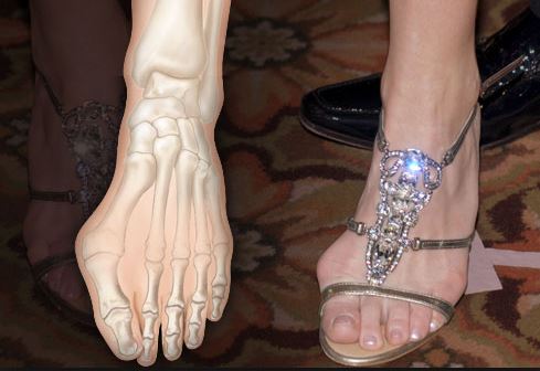 Bunion Pain