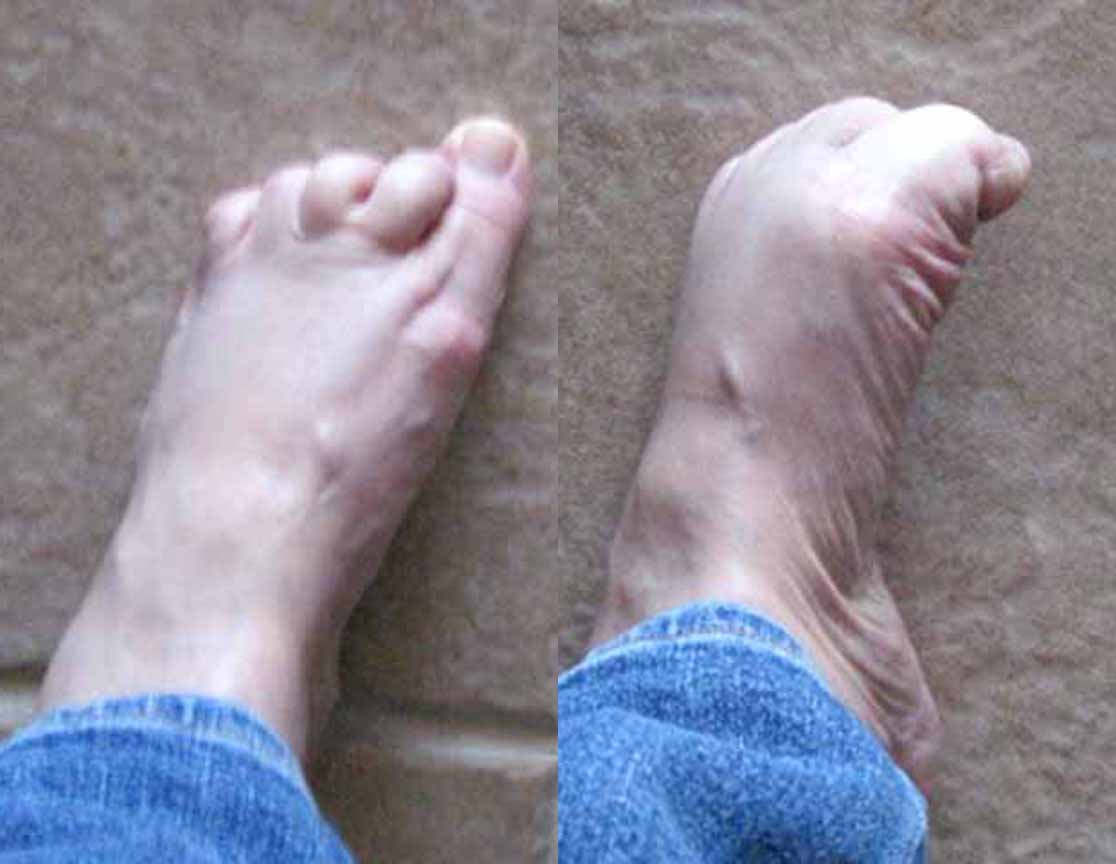 Hammer Toe