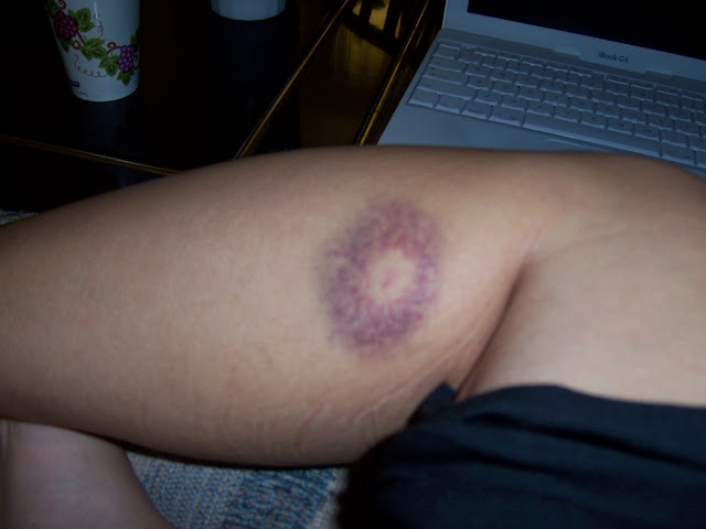 Bruises With White Center Dietrusaber1979のブログ