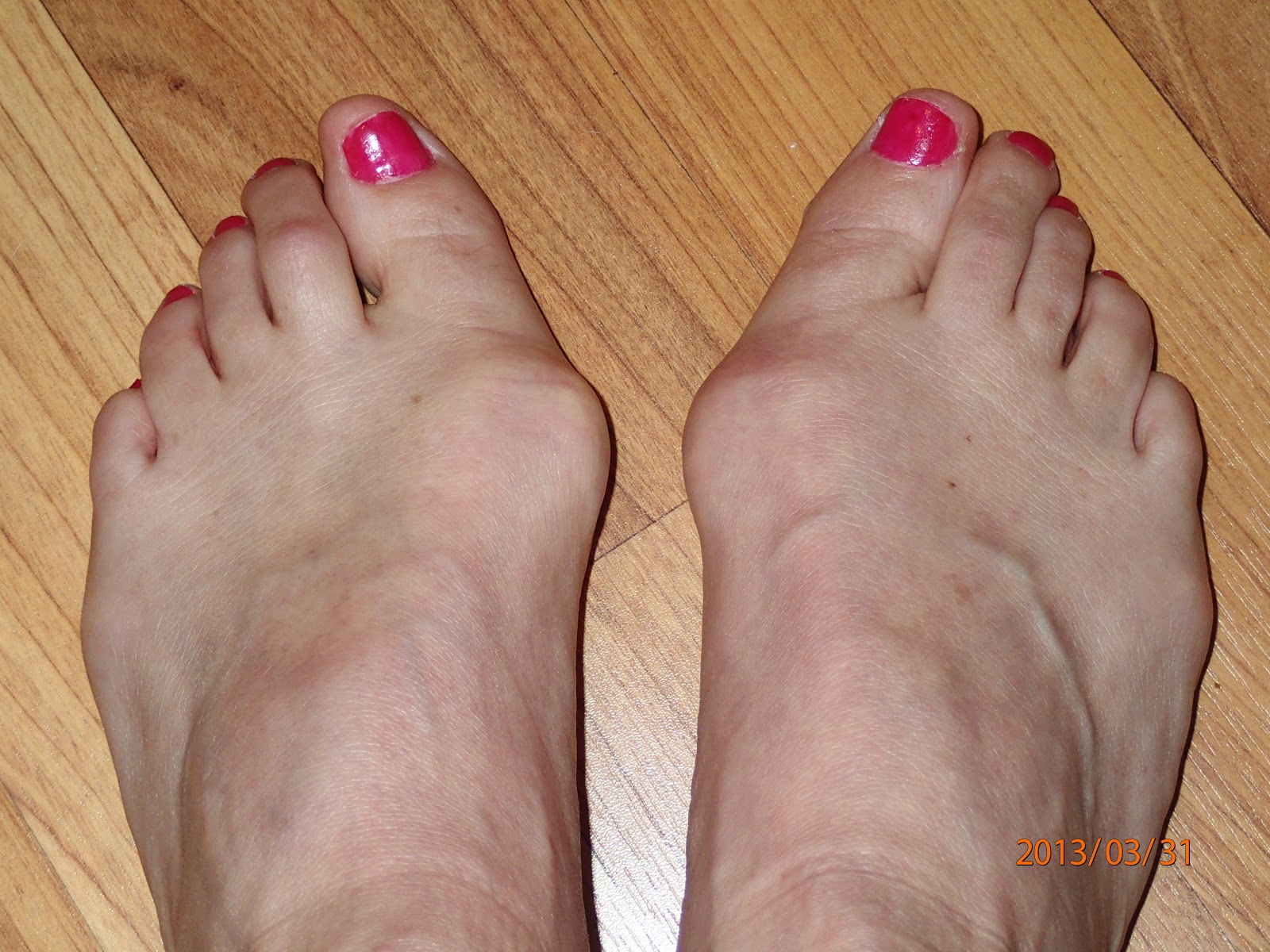 Hammer Toe