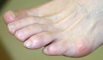 Bunions Callous