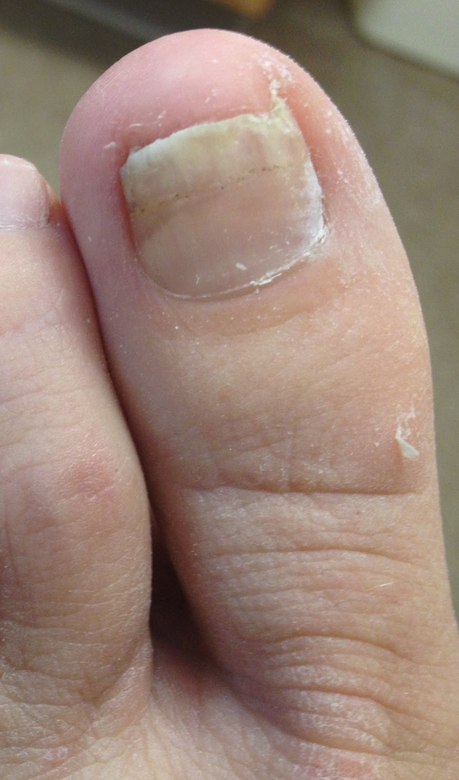 Hammer Toe