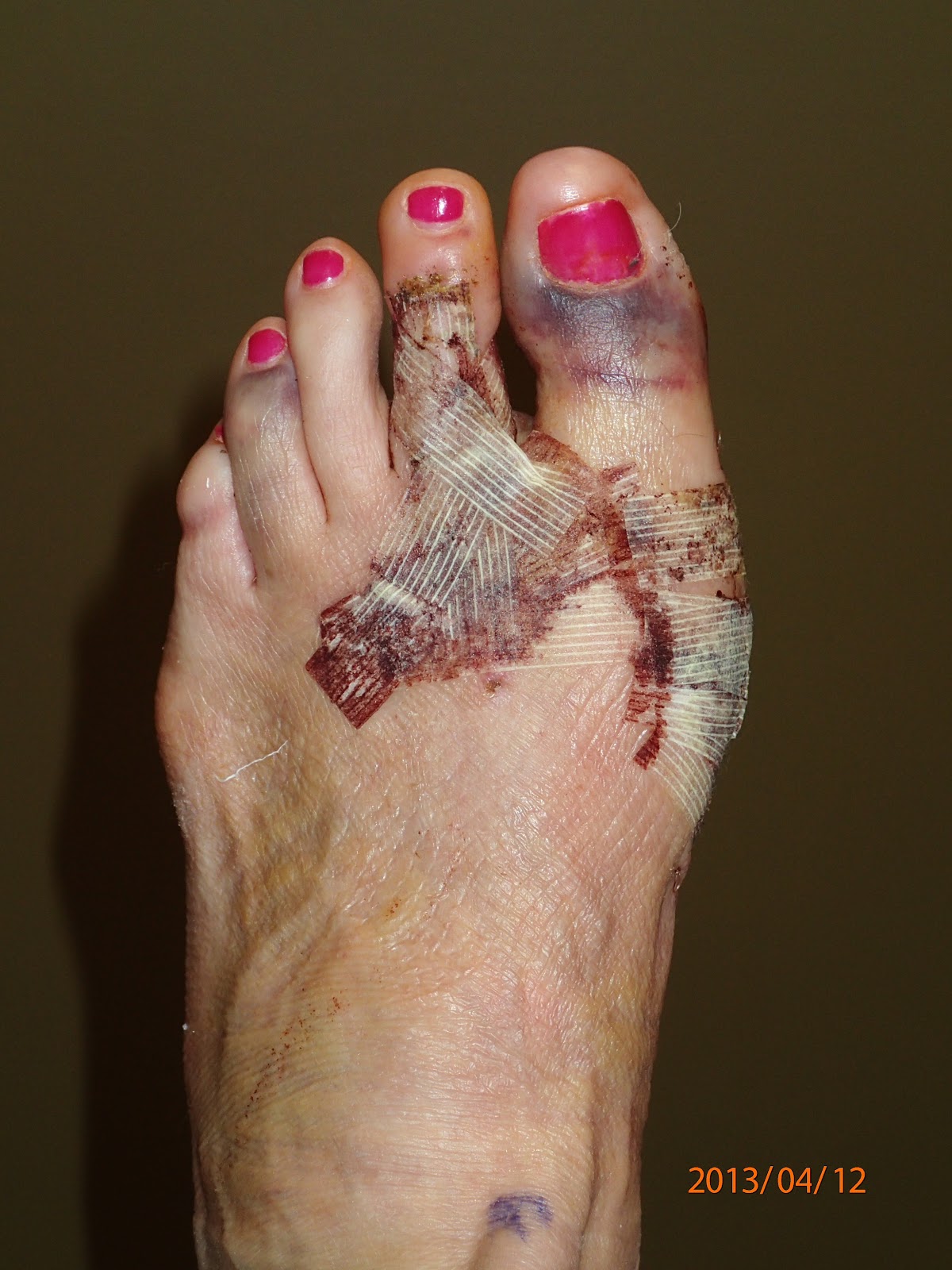 Hammer Toe