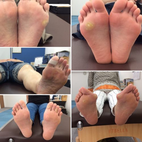 多くの人が悩まされている 中足骨骨頭痛 横アーチの低下 A1ssportsのブログ 多くの人が悩まされている 中足骨骨頭痛 横アーチの低下 A1ssportsのブログ