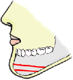 顎の整形の図解