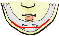 顎の整形の図解