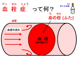 血栓症110