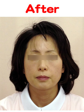 美容鍼　After