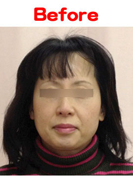 美容鍼　Before