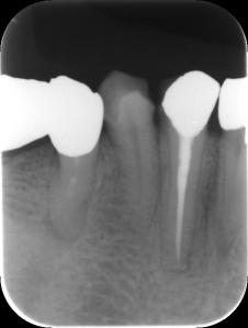 Kr.野中 根充後6か月