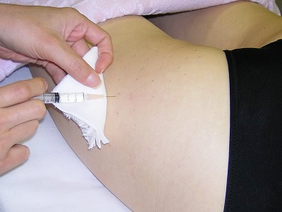 lipo01_ope.jpg