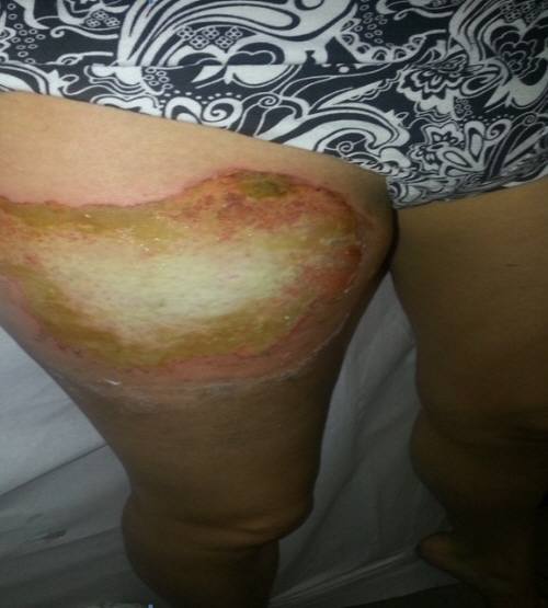 サムスン製のスマホが爆発！18歳のフランス人女性が大火傷を負う