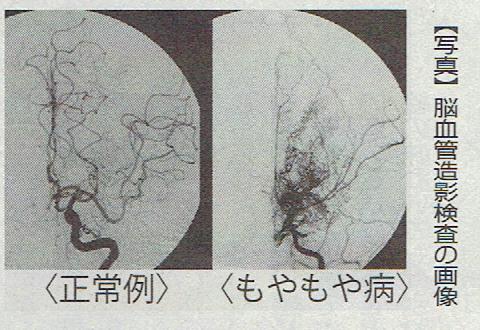 もやもや病