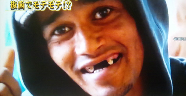 前歯なしイメージ