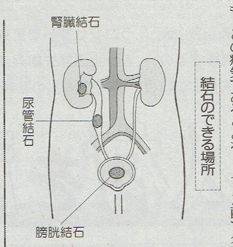 結石１