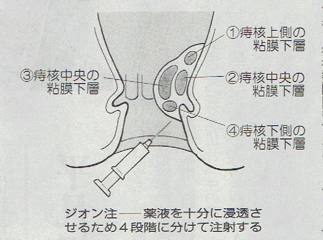 ジオン注