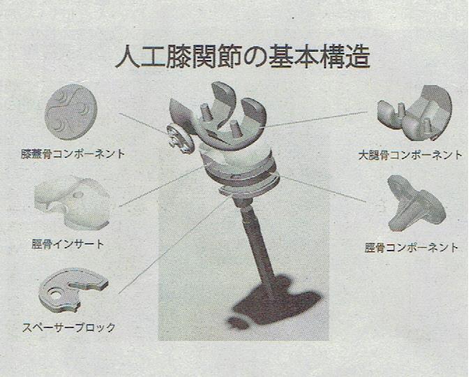 人工関節