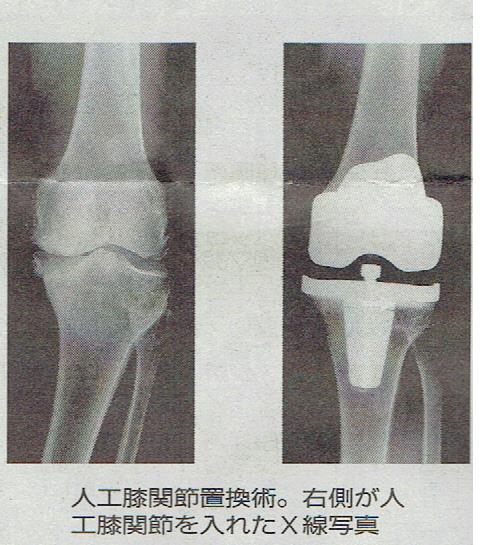 人工膝