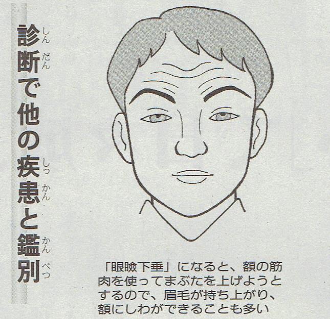眼瞼下垂１