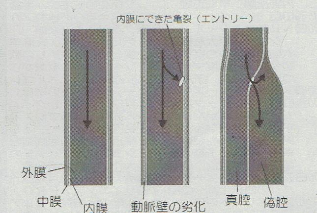 亀裂