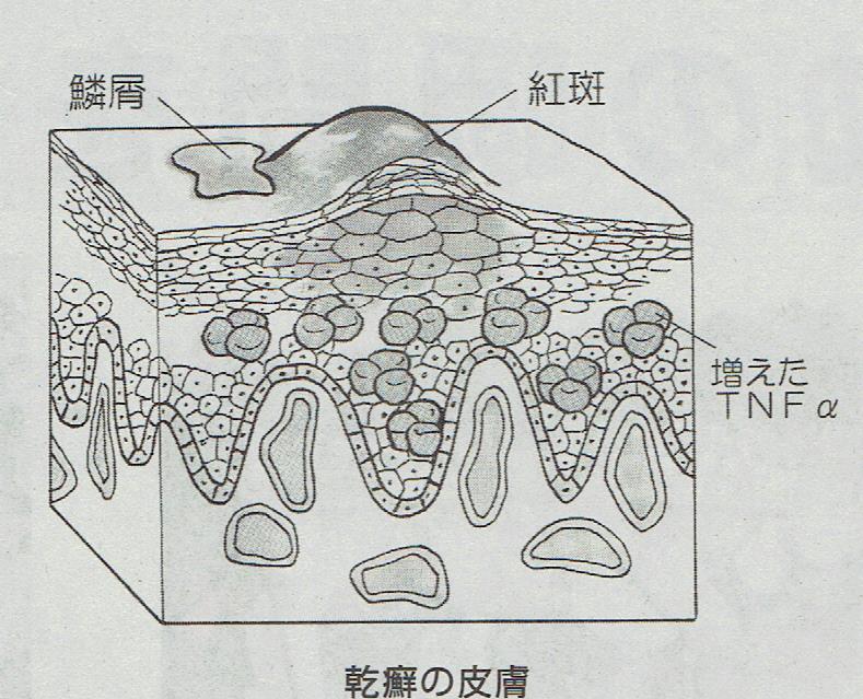 乾癬