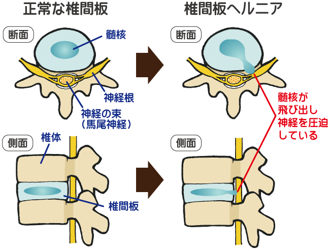 「腰椎椎間板ヘルニア　画像」の画像検索結果