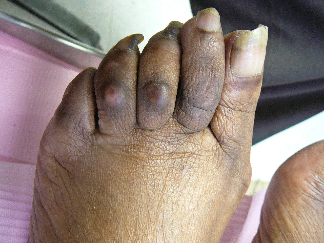 Hammer Toe