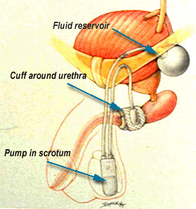 Artificial Urinary Sphincter SURGERY.