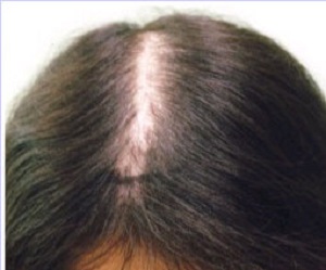 梅雨バテで頭頂部の髪が薄くなる 女性1000人の発毛実績49歳 92歳まで白髪を黒髪に再生させる専門家 頭皮博士おのれいこのブログ
