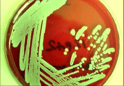 Antistaphylococcal (MSSA, MRSA, MSSE,.