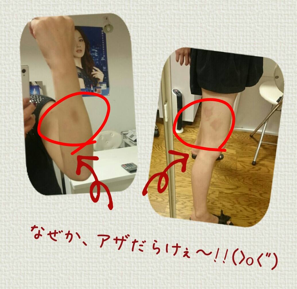 Cenbless　アザだらけ