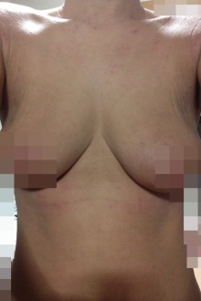 私のアトピー性皮膚炎-7