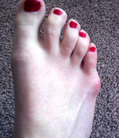 Bunion Pain