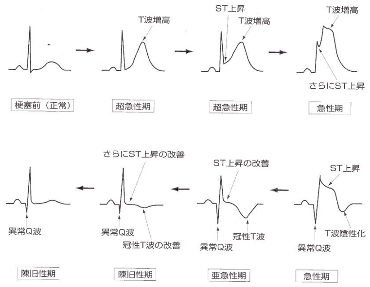 心電図 Wikipedia