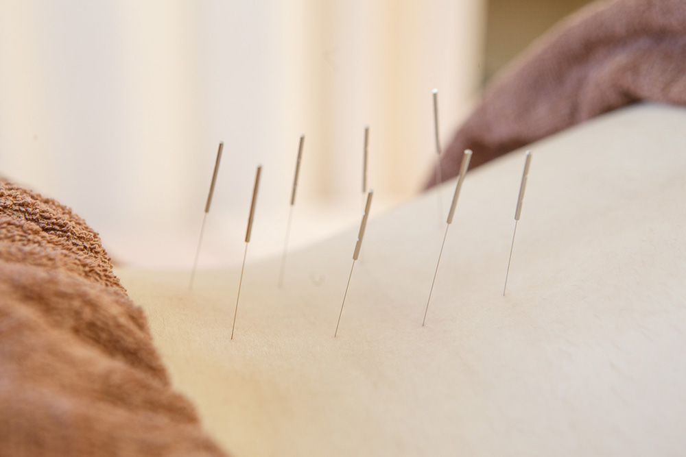 「鍼治療」の画像検索結果