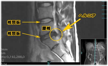 「椎間板ヘルニア」の画像検索結果