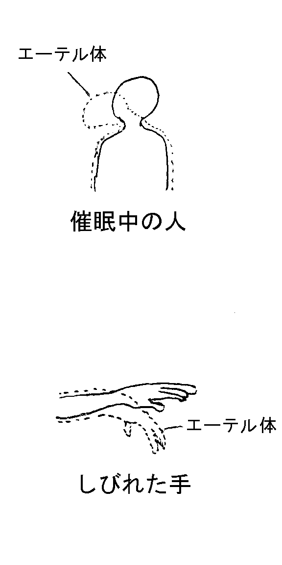 催眠中の人と痺れた手の様子