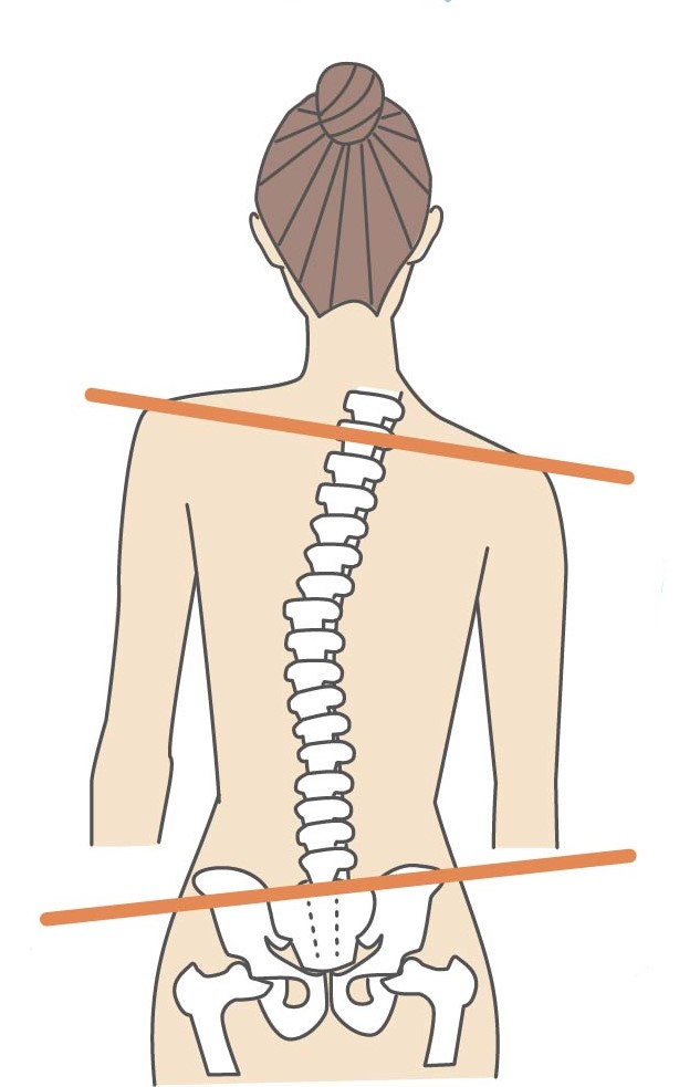 骨盤歪み
