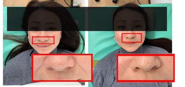 ほうれい線ケア1