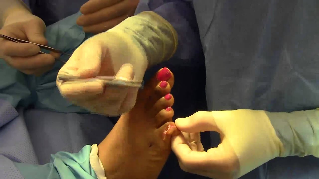 Hammer Toe