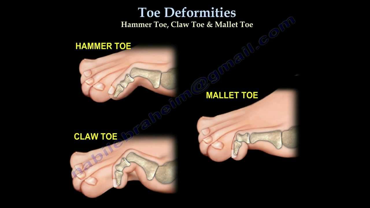 Hammertoe