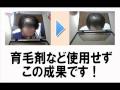 お笑いじゃすまないハゲ、薄毛、AGAの悩み！HSP発毛プログラム！