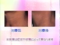 精美スキンケアクリニックの首のレーザーシワ治療をご紹介