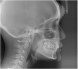 治療後　の　横顔レントゲン　です