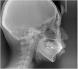 治療後　の　横顔レントゲン　です