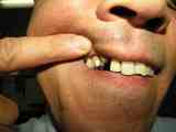 歯が折れた