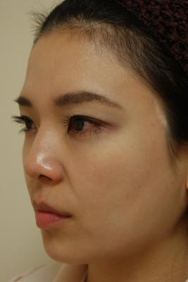 モデリスを額に入れて沢尻エリカ様のような女性らしい額にしませんか 美容のかかりつけ医を目指して