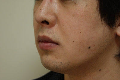 男性の顔の脂肪吸引1ヶ月後の経過 美容のかかりつけ医を目指して