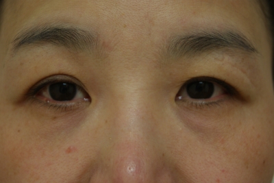 切らない眼瞼下垂と左目尻切開とプチアイリフトの１ヶ月後経過 美容のかかりつけ医を目指して